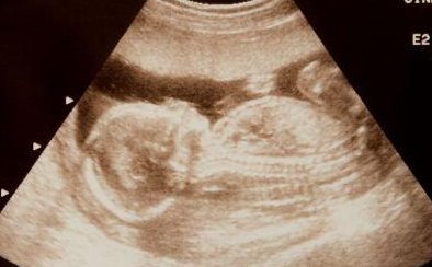 不孕不育在宜兴市做试管的费用有多少？一文告诉你做三代试管建档的流程有哪些