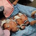 染色体易位在罗山县人民医院可以做三代试管吗？染色体平衡易位还能生健康的宝宝吗？